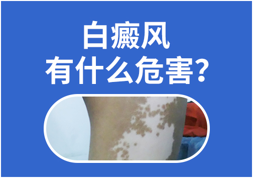 白癜风的危害有哪些